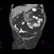 Unknown pathology, secondary finding, small bowel: CT - Computed tomography